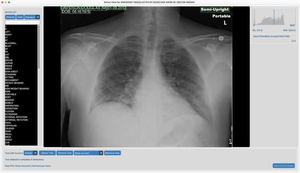 Detect Text on davidson_cxr