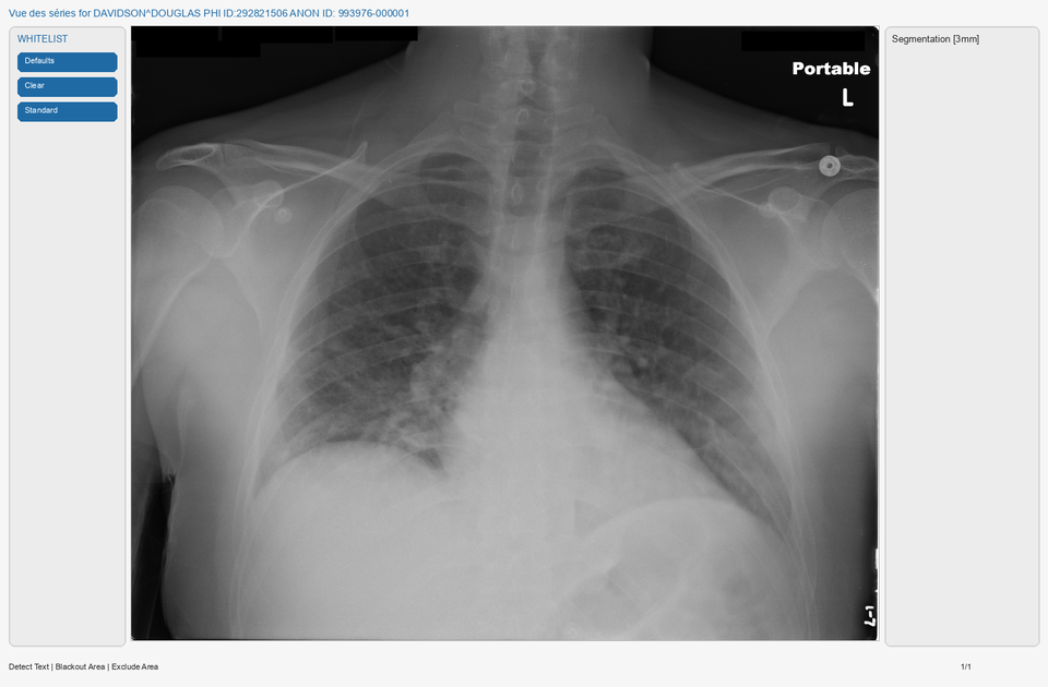 Supprimer le texte noircir sur davidson_cxr