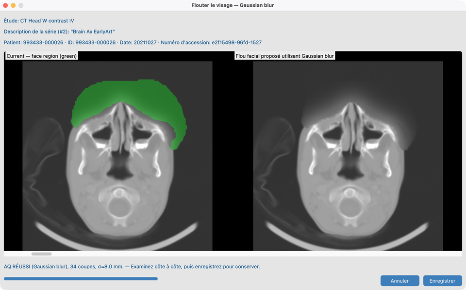 Flouter le visage Gaussien sur CT_Head_With_Contrast