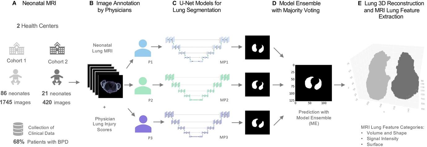 MRI-based neonatal lung segmentation and automated MRI analysis. (A) Clinical study including preterm infants with and without bronchopulmonary dysplasia (BPD). Free-breathing neonatal MRI was performed at mean gestational age of 37 weeks ± 5.8. (B) Manual MRI annotation of the lung was performed by three trained physicians (physician 1 [P1], physician 2 [P2], and physician 3 [P3]). MRI morphologic injuries (eg, emphysema, fibrosis, ventilation inhomogeneity) were scored by two trained physicians. (C, D) U-Net deep learning models (MP1, MP2, MP3) were trained for lung segmentation, and a final lung-mask prediction was calculated with an ensemble of the models (ME) through majority voting. (E) Lung volume three-dimensional (3D) reconstruction and automated calculation of 78 lung morphologic 3D descriptors.
